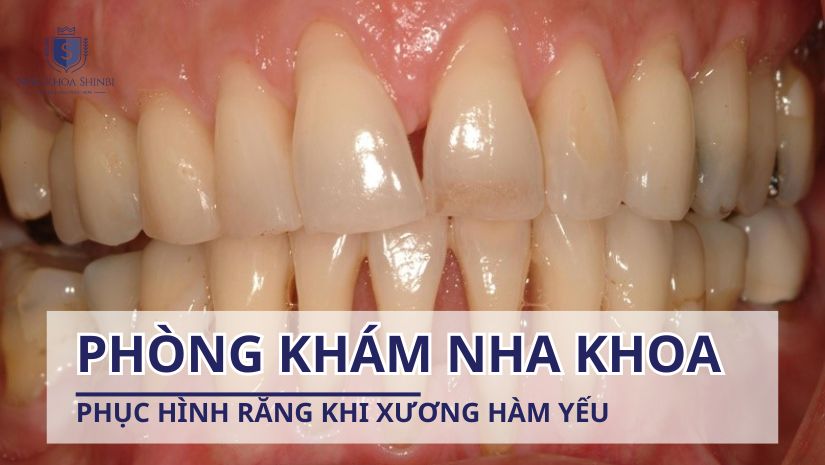 Bác sĩ nha khoa chuyên phục hình răng khi xương hàm yếu
