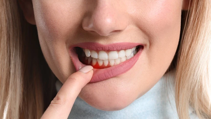 Bệnh nha chu: Dấu hiệu, Nguyên nhân và Cách điều trị
