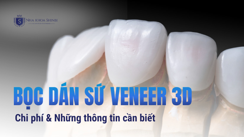 Bọc dán sứ Veneer 3D: Chi phí & Những thông tin cần biết