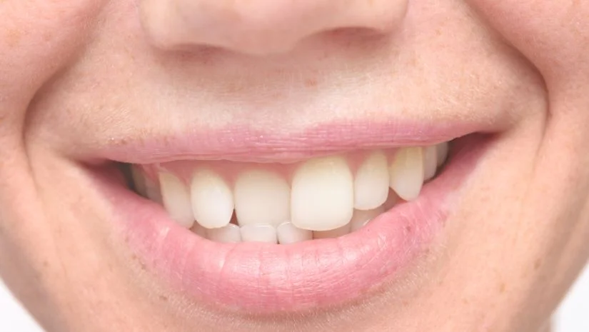 Bọc răng sứ cho răng lệch lạc: Đối tượng phù hợp và Lưu ý