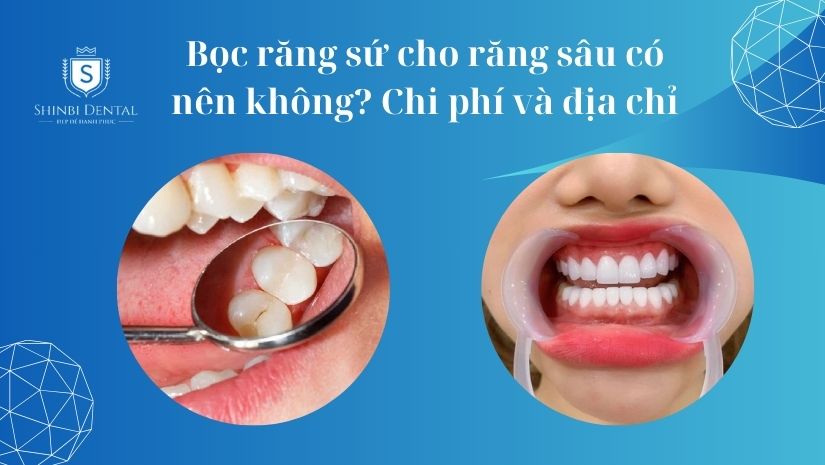 Bọc răng sứ cho răng sâu có nên không? Chi phí và địa chỉ