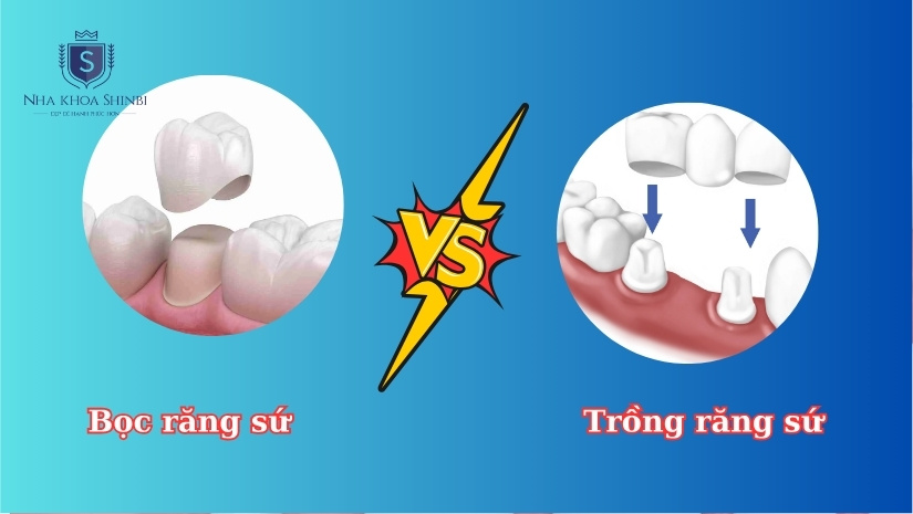 Bọc răng sứ và trồng răng sứ có sự khác biệt như thế nào?