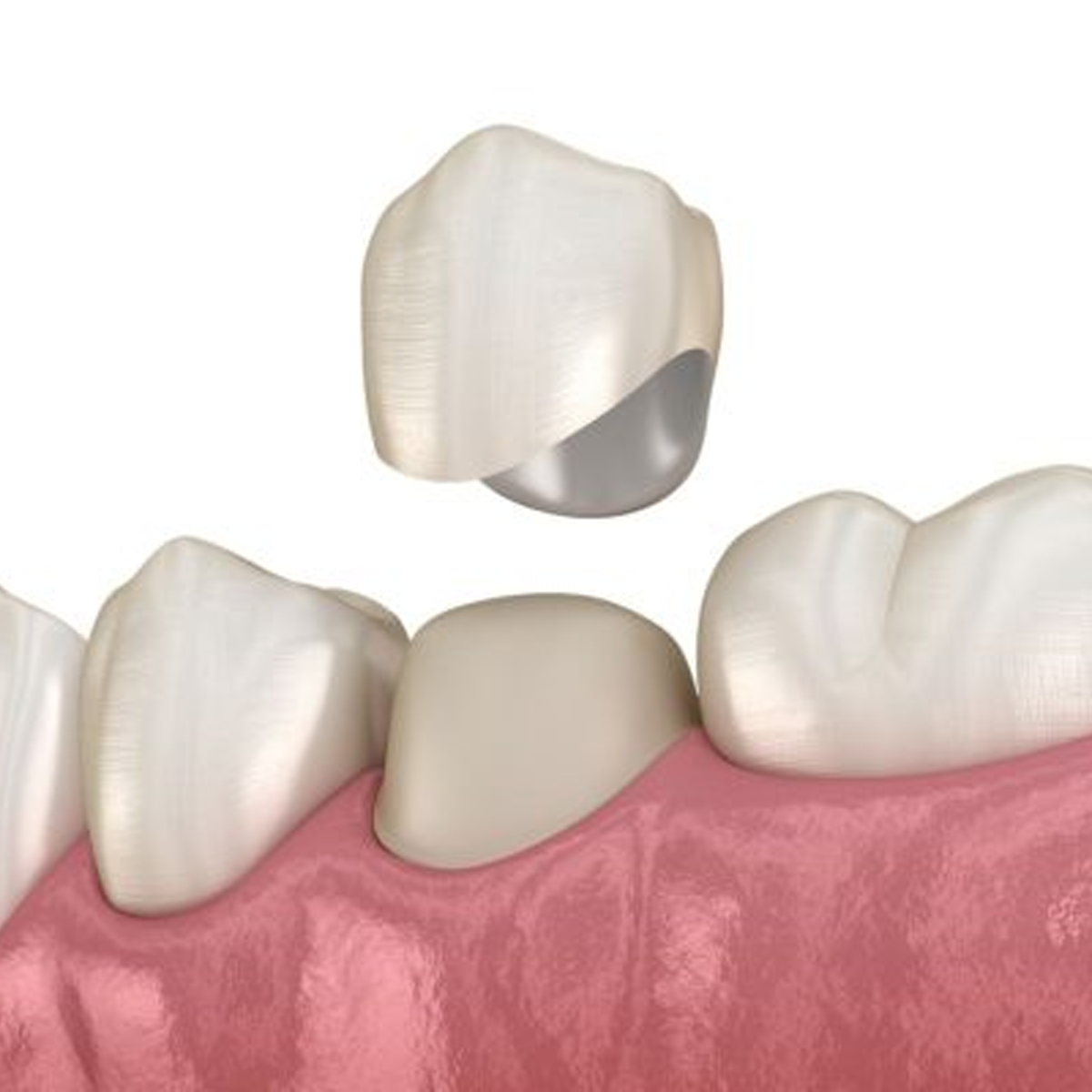 Dịch vụ răng sứ 3D Promax