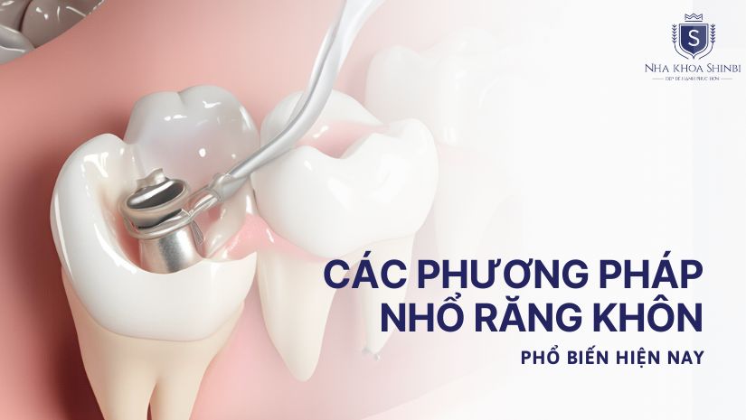 Các phương pháp nhổ răng khôn phổ biến hiện nay