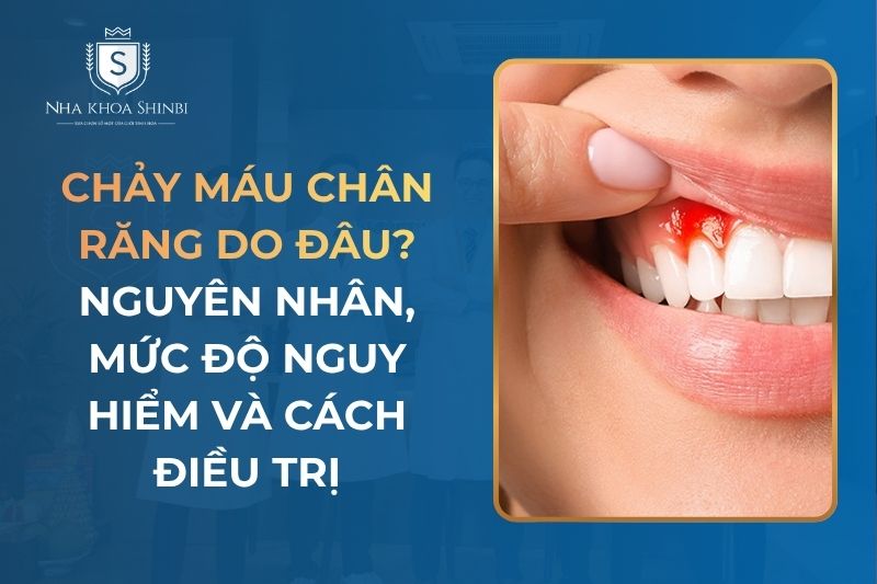 Chảy Máu Chân Răng Do Đâu? Nguyên Nhân, Mức Độ Nguy Hiểm và Cách Điều Trị