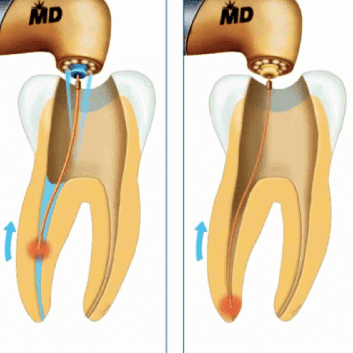 Điều trị tủy lại