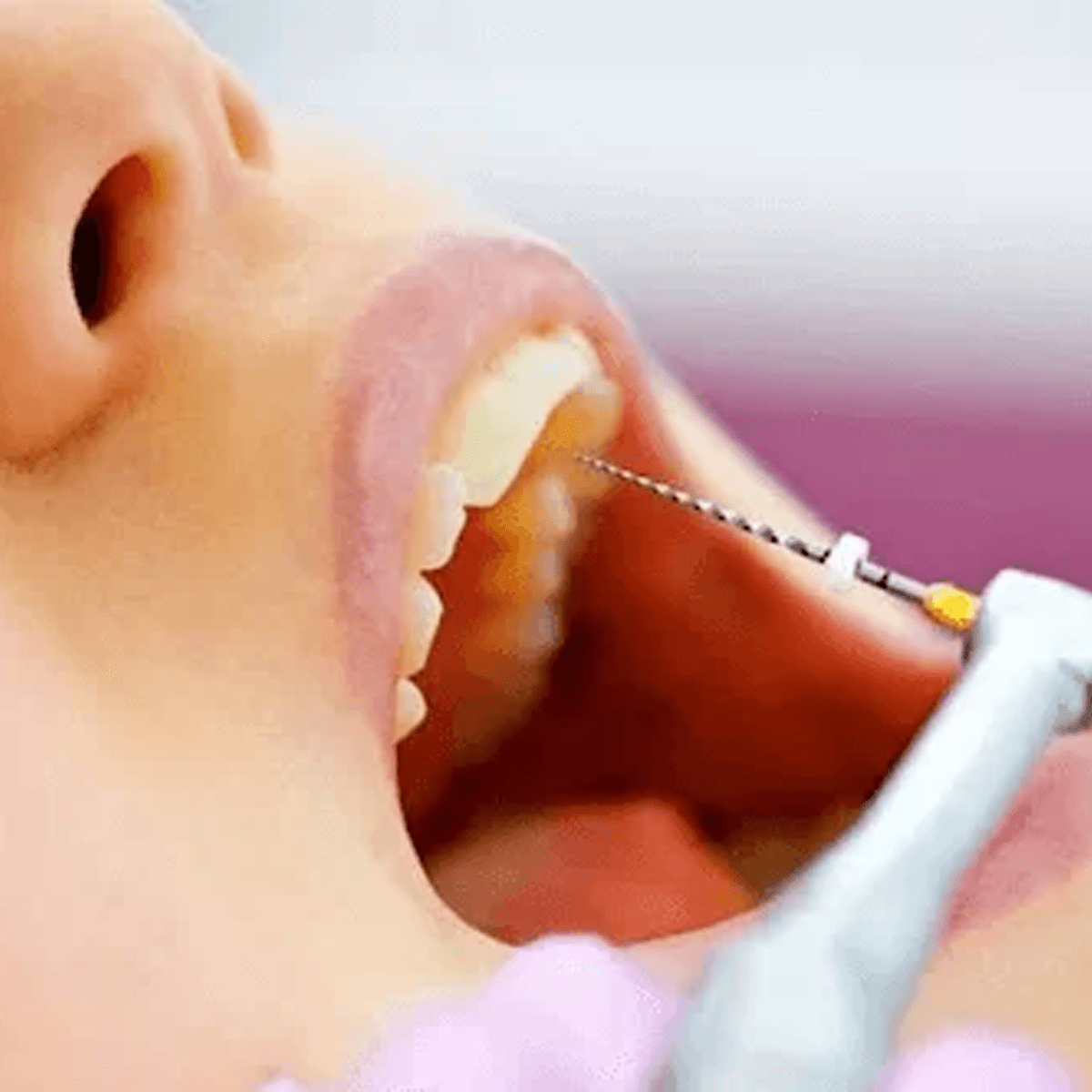 Điều trị tủy răng cửa trên dưới