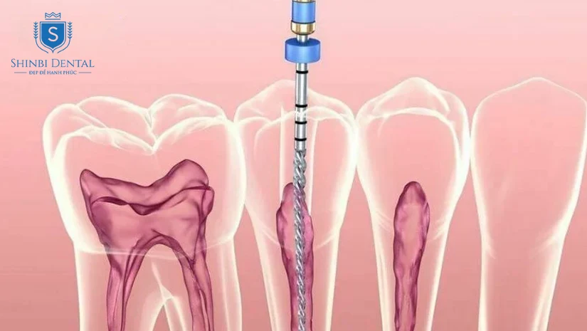 Điều trị tủy: Dấu hiệu, Lợi ích và Quy trình thực hiện
