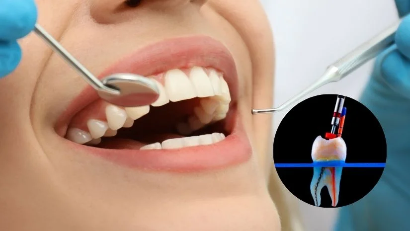 Giá bọc răng sứ sau khi lấy tủy & Lưu ý trước khi bọc răng