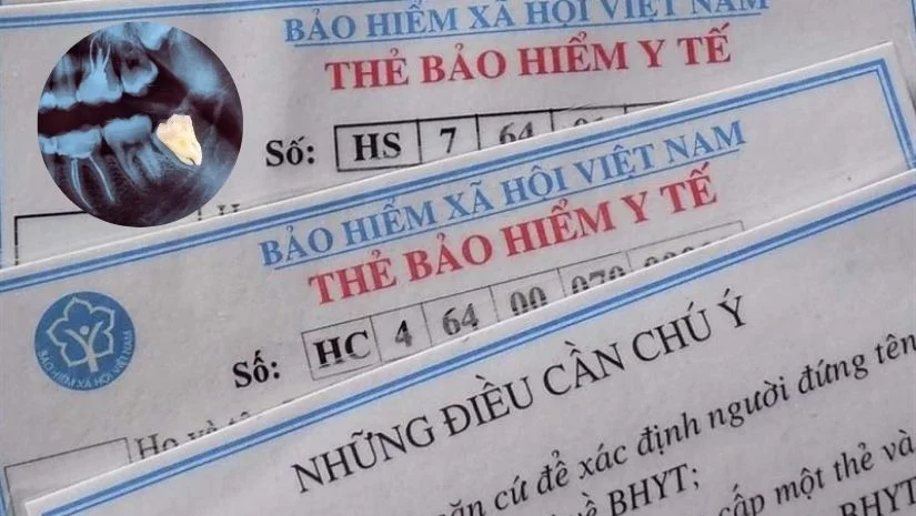 Giá nhổ răng khôn khi có bảo hiểm Y tế là bao nhiêu?