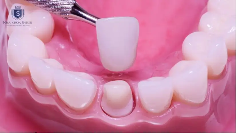 Có nên làm răng sứ có cùi giả không? Trường hợp nào nên làm?