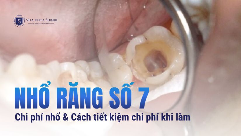 Nhổ răng số 7 giá bao nhiêu? [Bảng giá nhổ răng số 7]