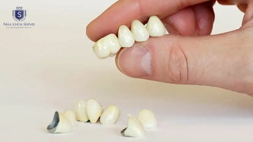 Quy trình bọc răng sứ Titan đúng chuẩn quốc tế mới nhất 2025