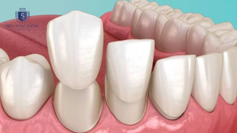 Quy trình dán sứ veneer chuẩn y khoa chi tiết nhất