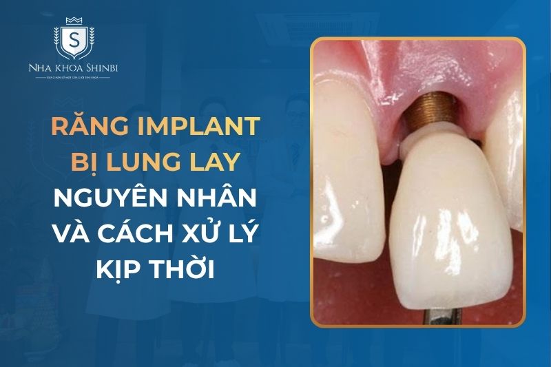 Răng Implant bị lung lay: Nguyên nhân và cách xử lý kịp thời