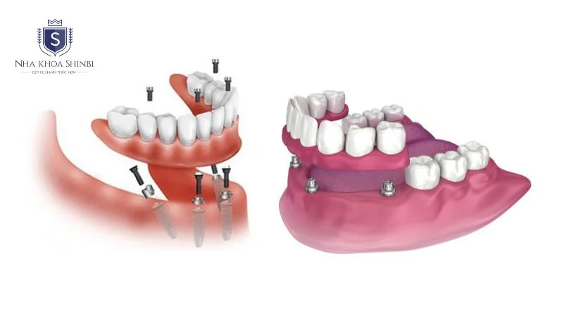 Trồng răng implant nguyên hàm cho người mất nhiều răng