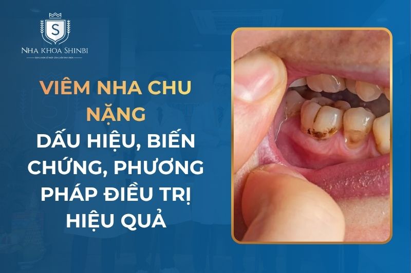 Viêm Nha Chu Nặng Dẫn Có Thể Dẫn Đến Biến Chứng Nguy Hiểm Và Phương Pháp Điều Trị